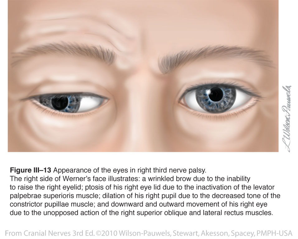 cniii compression and fixed dilated pupil