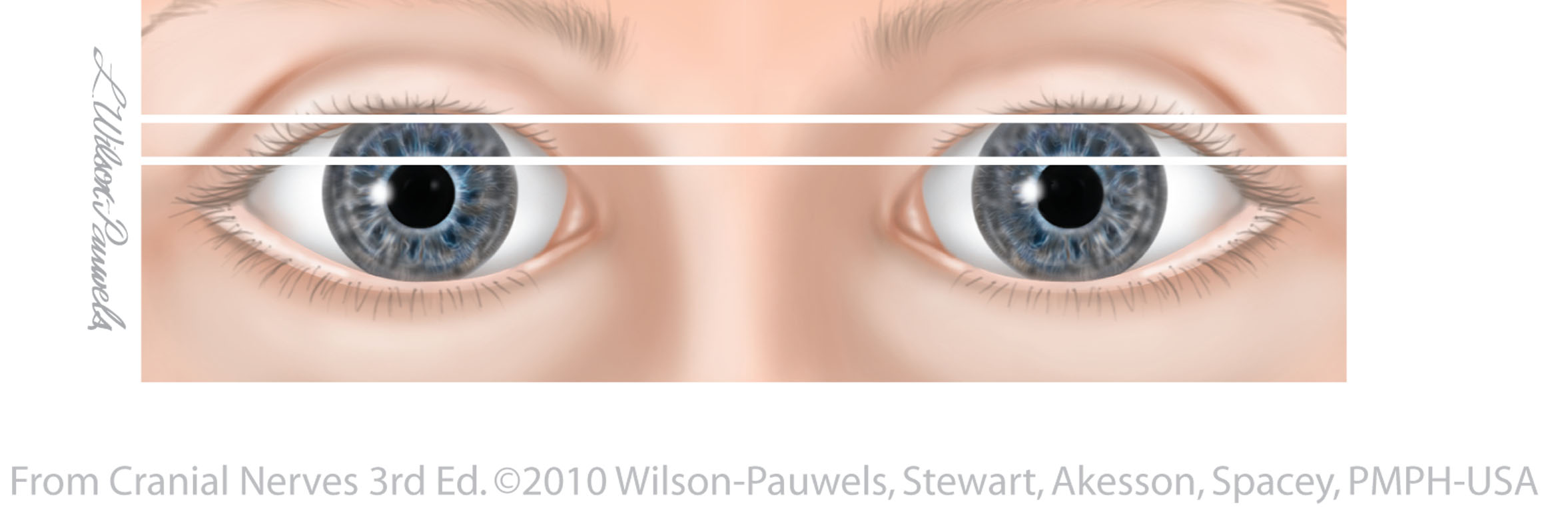 miotic pupil oculomotor