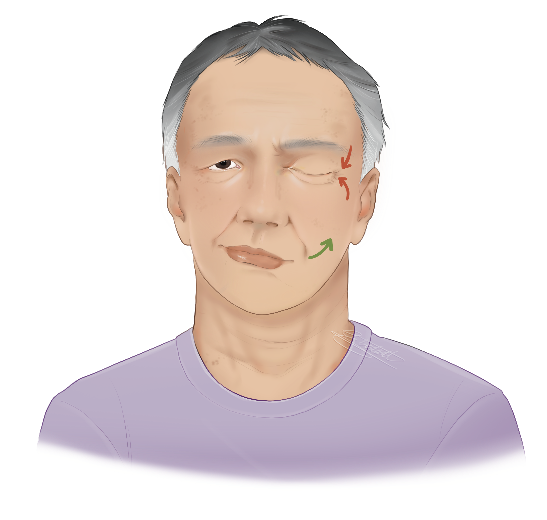 An image of an older asian man with left sided facial paralysis trying to smile and his eye closed involuntarily as well.