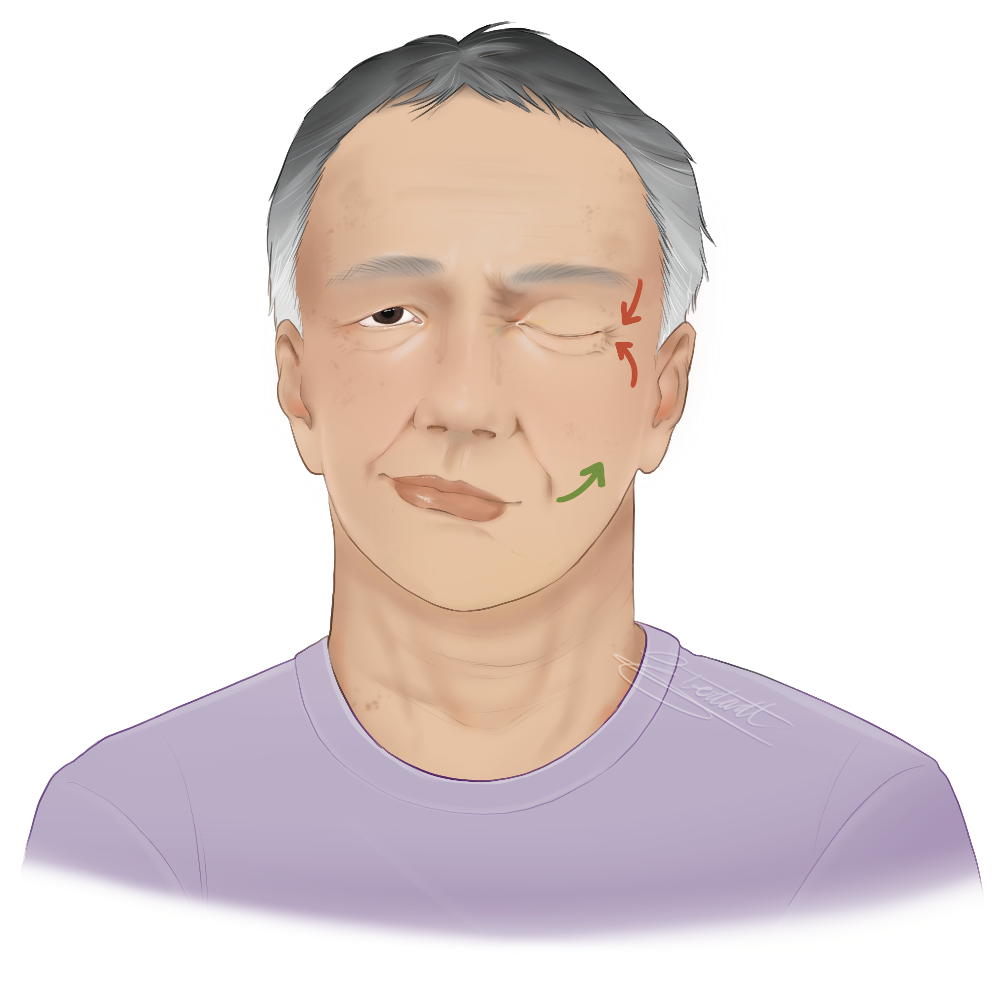 Image of a middle aged white woman with right-sided facial paralysis smiling. The paralyized side is not moving and her expression is pulled to the left.